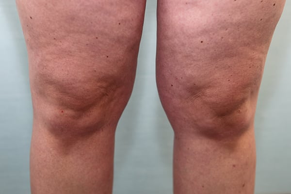Liposuction Knees Before & After Patient Photo
