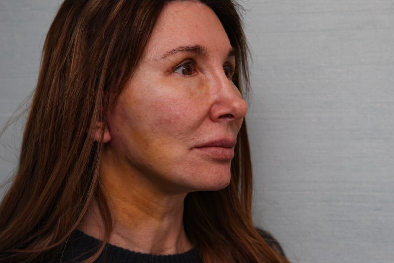 Jawline-Refine Before & After Patient Photo