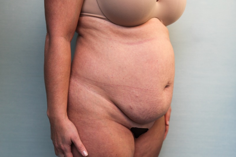 Abdominoplasty Before & After Patient Photo