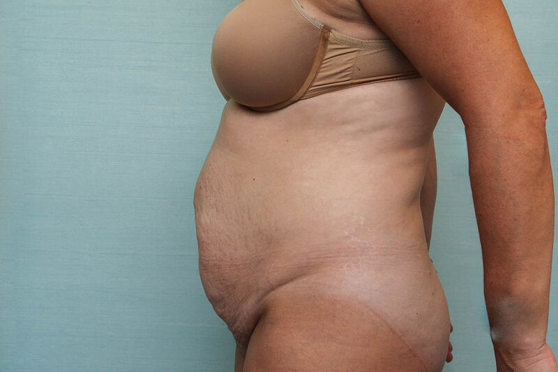 Abdominoplasty Before & After Patient Photo