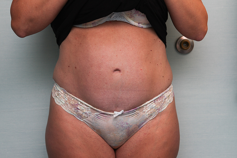 Abdominoplasty Before & After Patient Photo