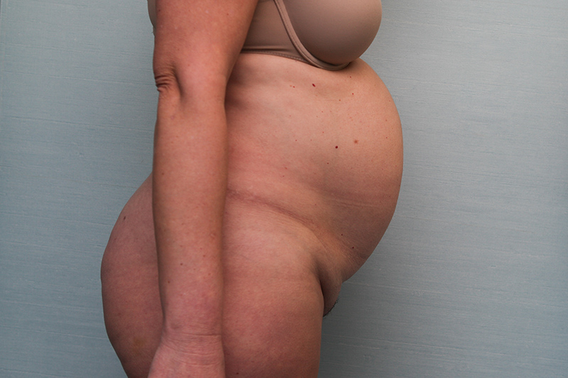 Abdominoplasty Before & After Patient Photo