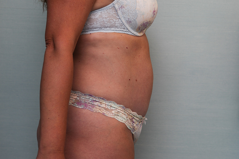 Abdominoplasty Before & After Patient Photo