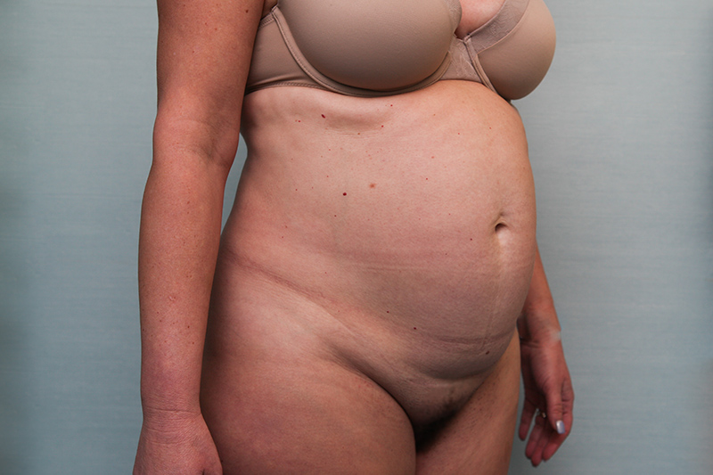 Abdominoplasty Before & After Patient Photo