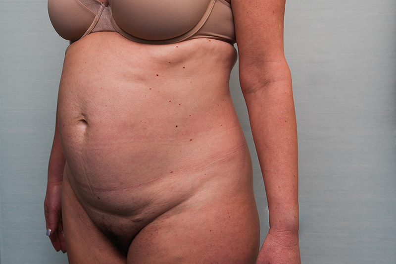 Abdominoplasty Before & After Patient Photo