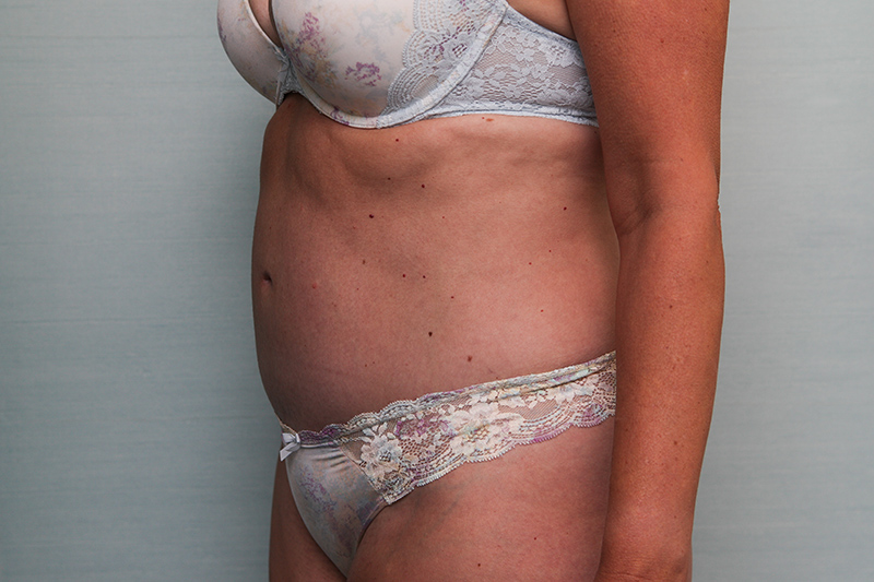 Abdominoplasty Before & After Patient Photo