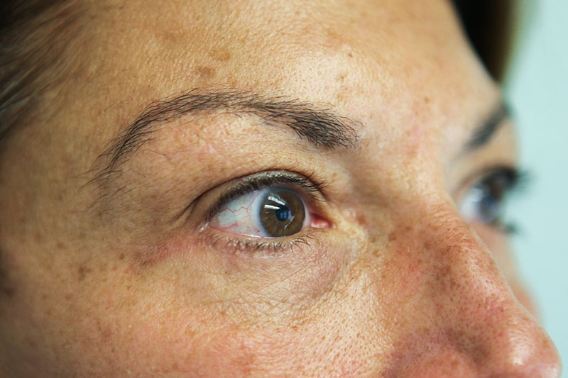 Lower Blepharoplasty Before & After Patient Photo