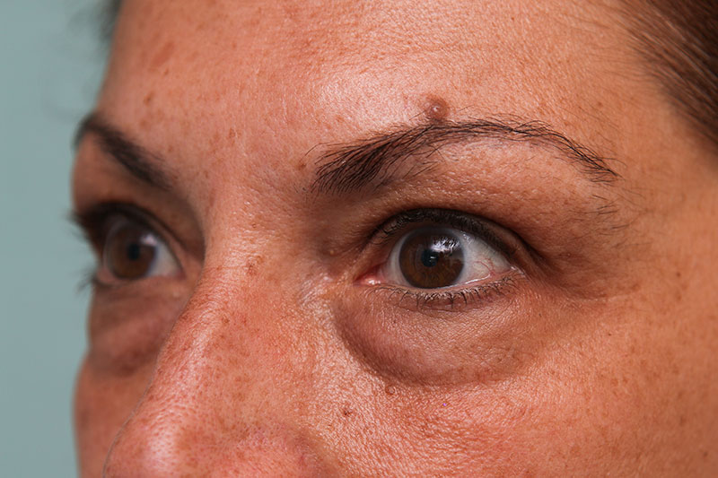 Lower Blepharoplasty Before & After Patient Photo