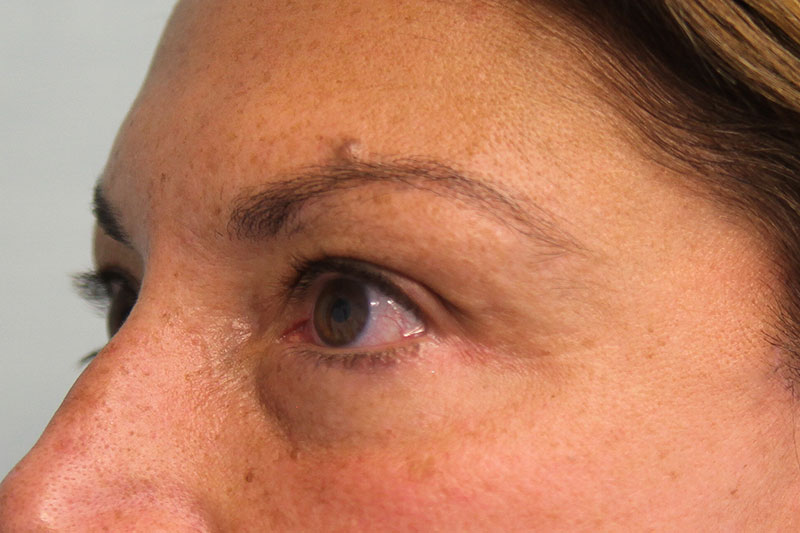 Lower Blepharoplasty Before & After Patient Photo