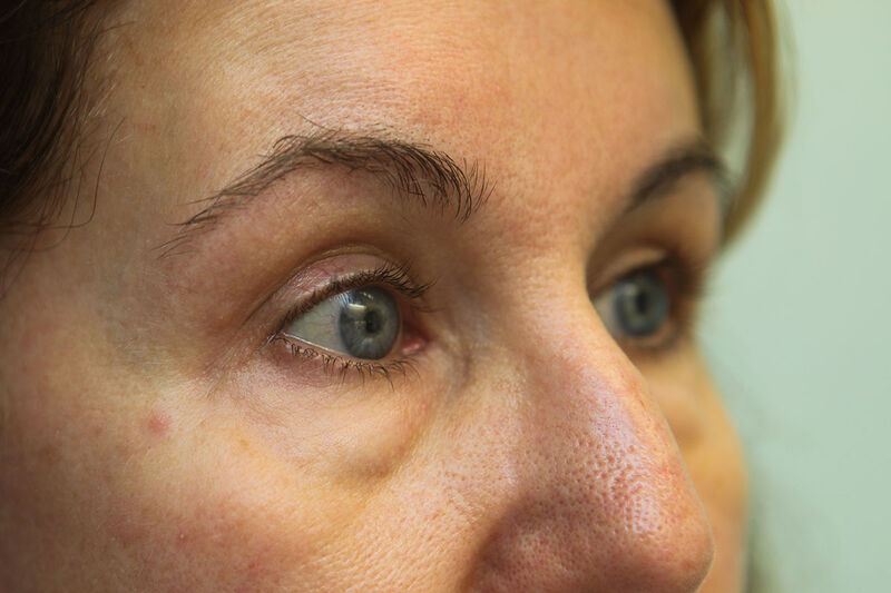 Lower Blepharoplasty Before & After Patient Photo