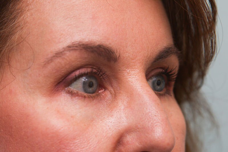 Lower Blepharoplasty Before & After Patient Photo