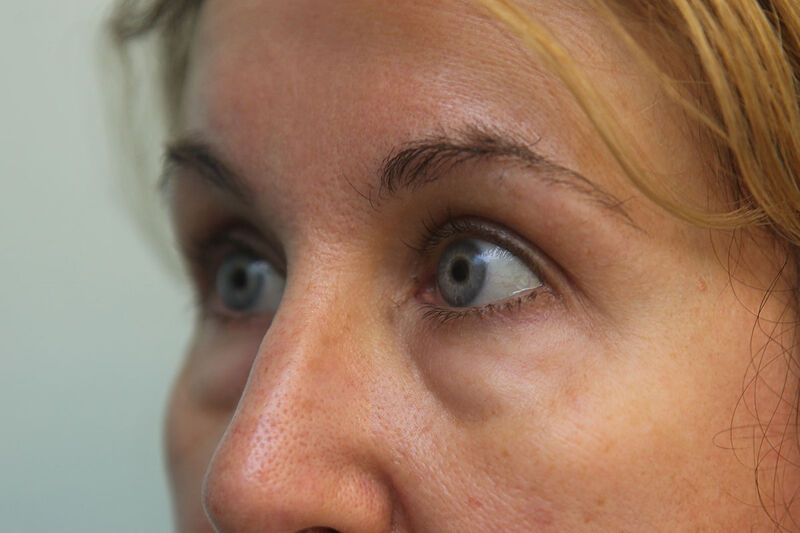 Lower Blepharoplasty Before & After Patient Photo