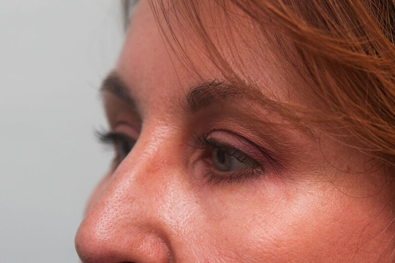 Lower Blepharoplasty Before & After Patient Photo