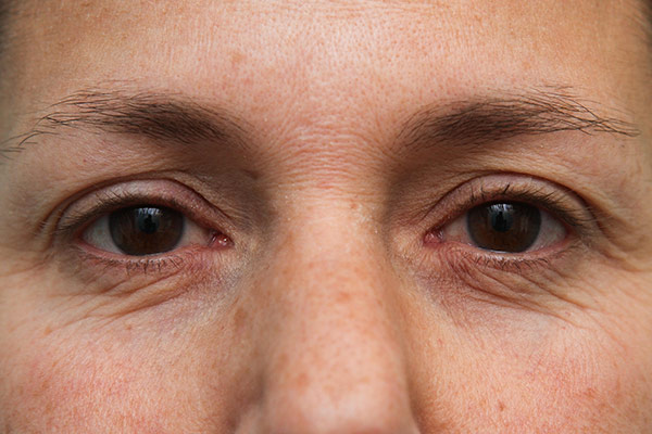 Lower Blepharoplasty Before & After Patient Photo