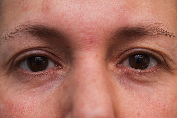 Lower Blepharoplasty Before & After Patient Photo