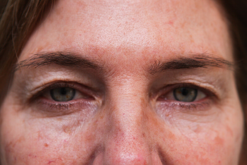 Upper Blepharoplasty Before & After Patient Photo