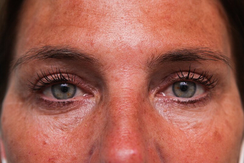 Upper Blepharoplasty Before & After Patient Photo